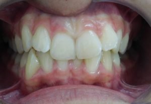 Antes del tratamiento mordida anterior caso 3