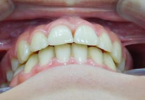 Después del tratamiento overjet caso 3